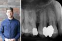 Nicholas Lowe needed a root canal after decay under two fillings was allegedly missed