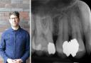 Nicholas Lowe needed a root canal after decay under two fillings was allegedly missed